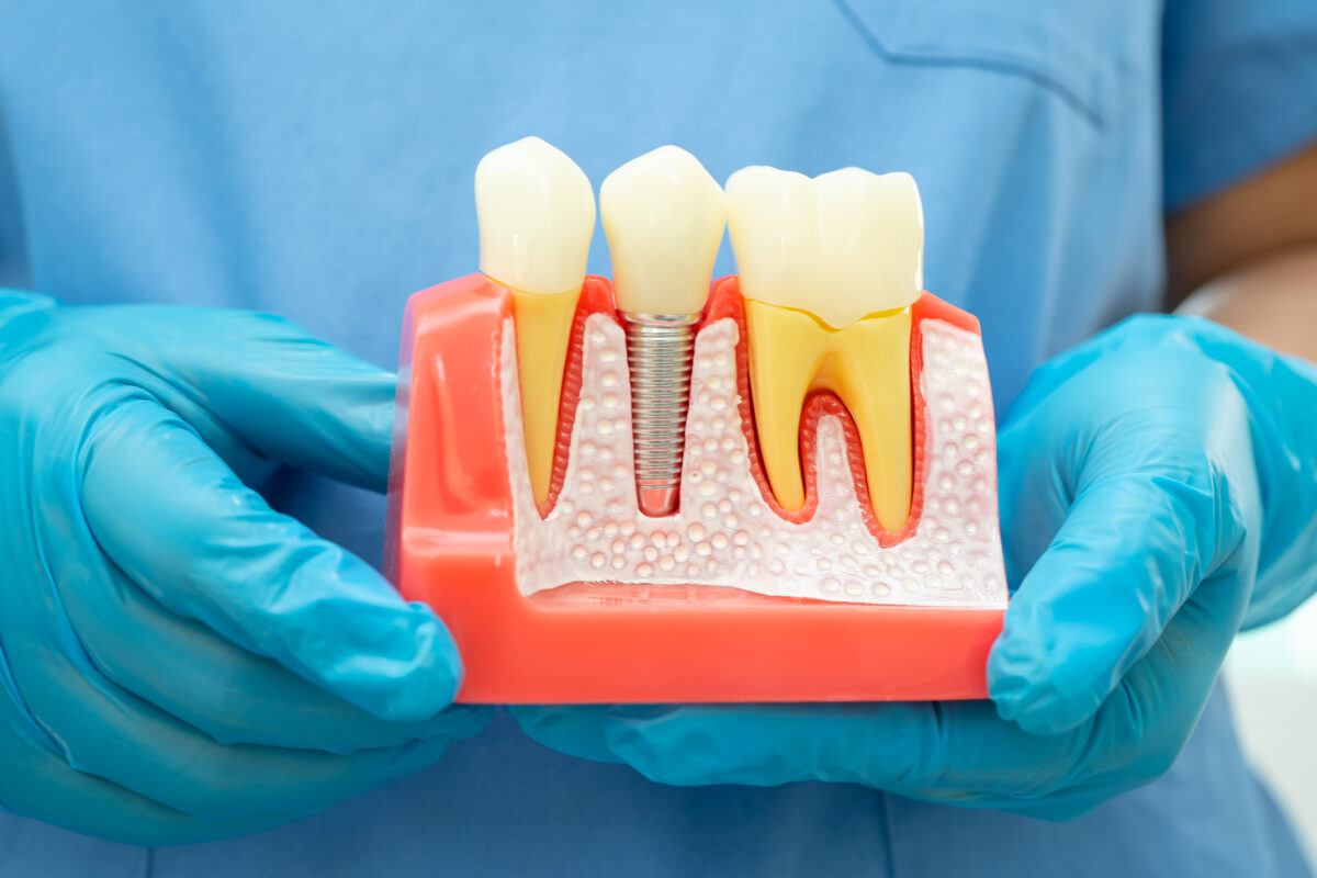 Dental implant, artificial tooth roots into jaw, root canal of d